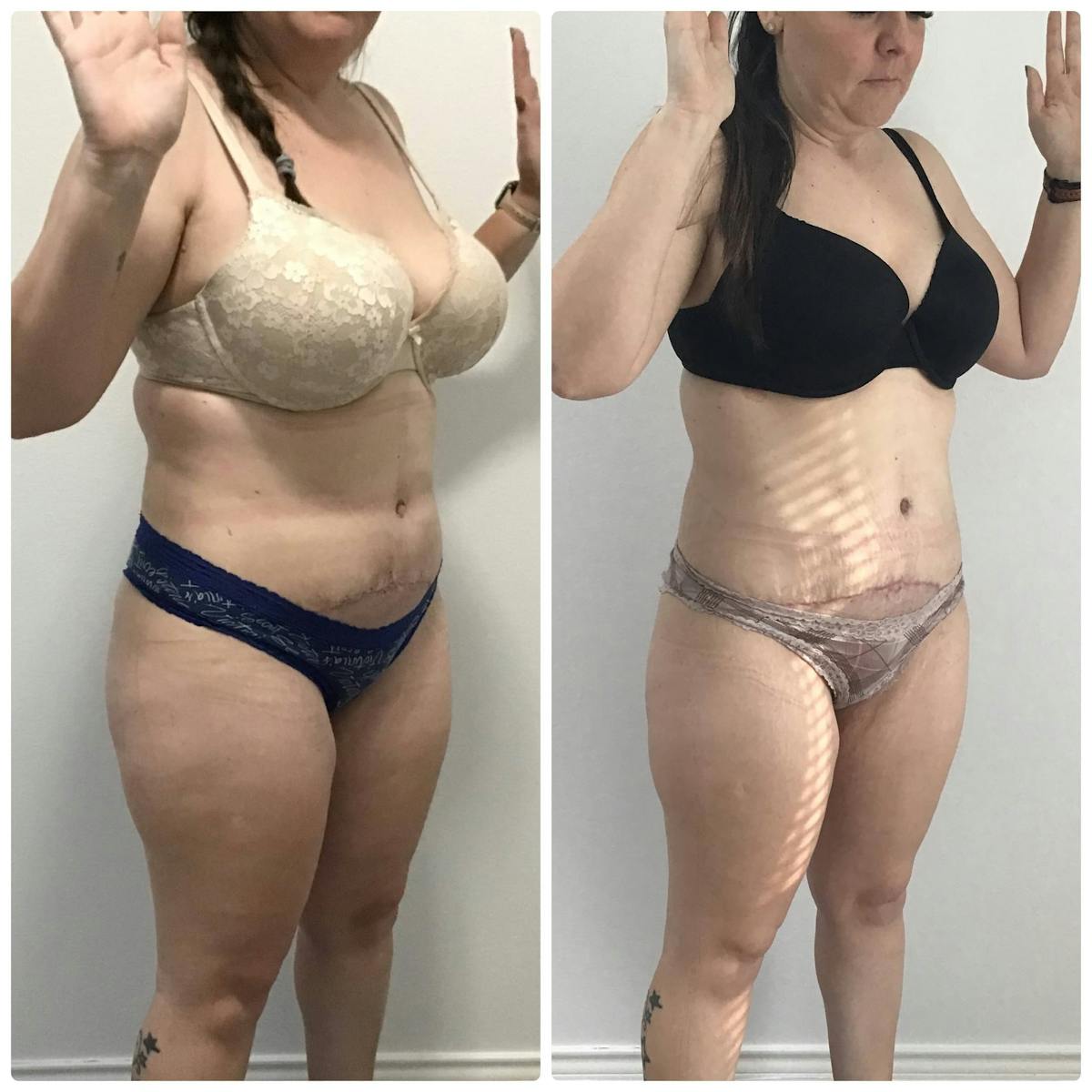 Coolsculpting Before & After Gallery - Patient 187087364 - Image 1