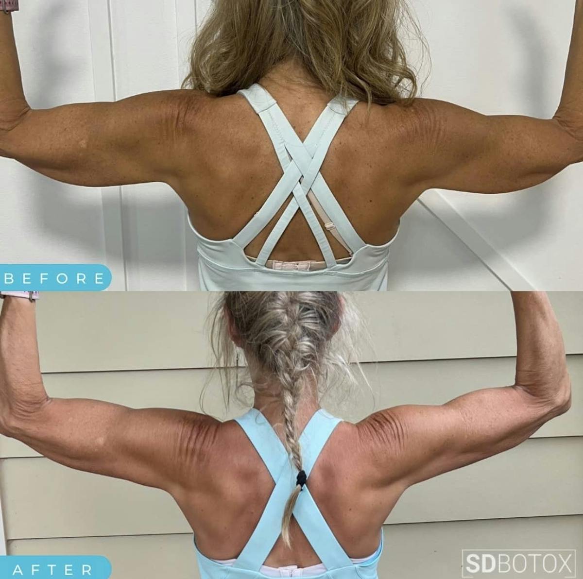 Coolsculpting Before & After Gallery - Patient 187087365 - Image 1