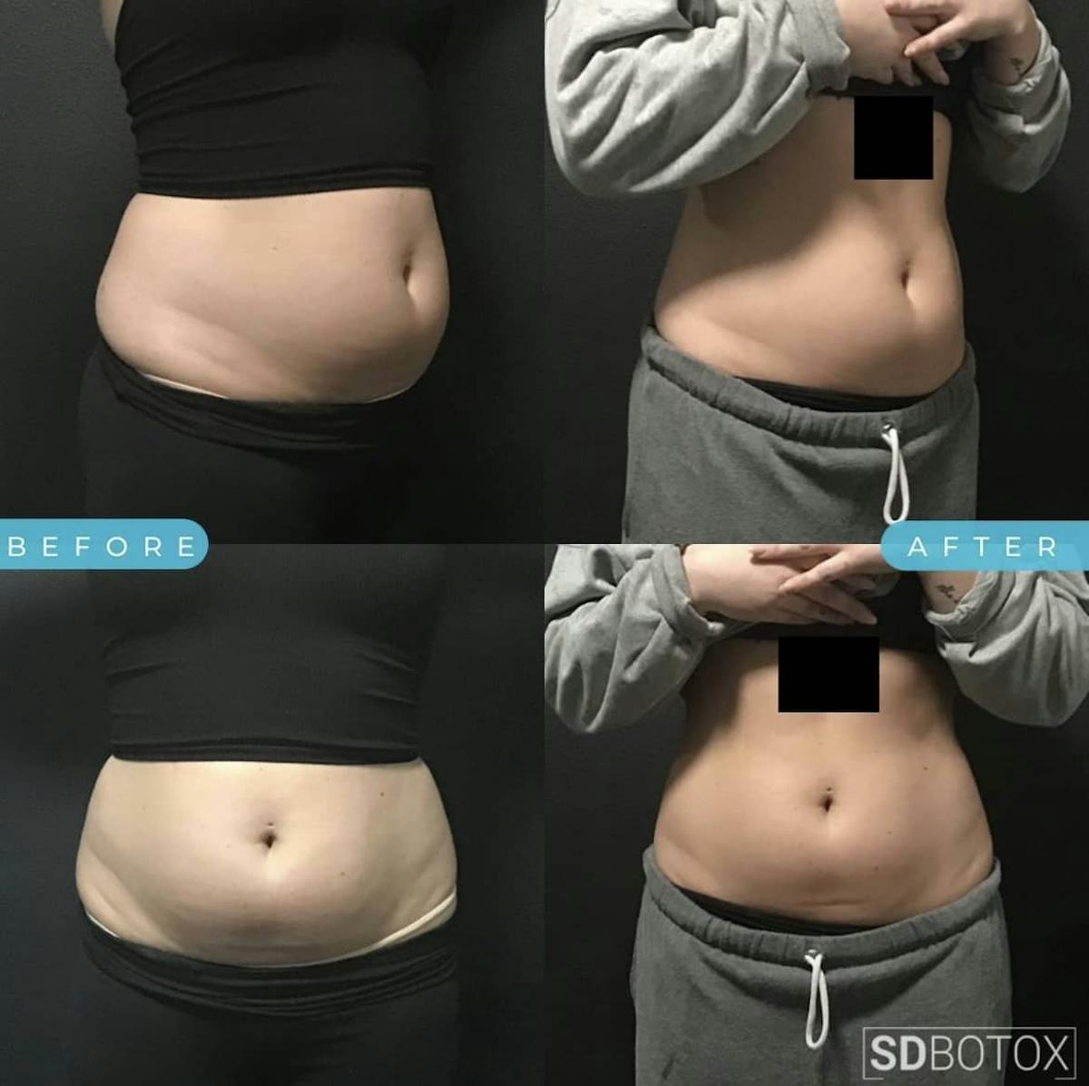 Coolsculpting Before & After Gallery - Patient 187087366 - Image 1