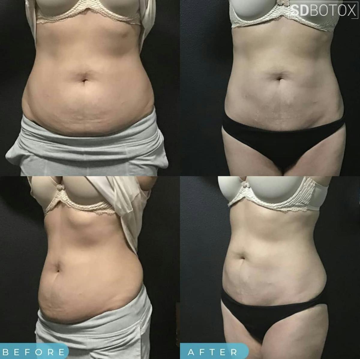 Coolsculpting Before & After Gallery - Patient 187087367 - Image 1