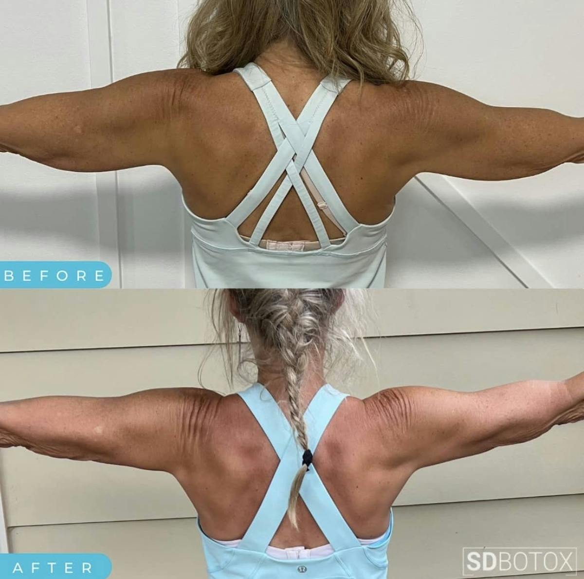 Coolsculpting Before & After Gallery - Patient 187087365 - Image 2