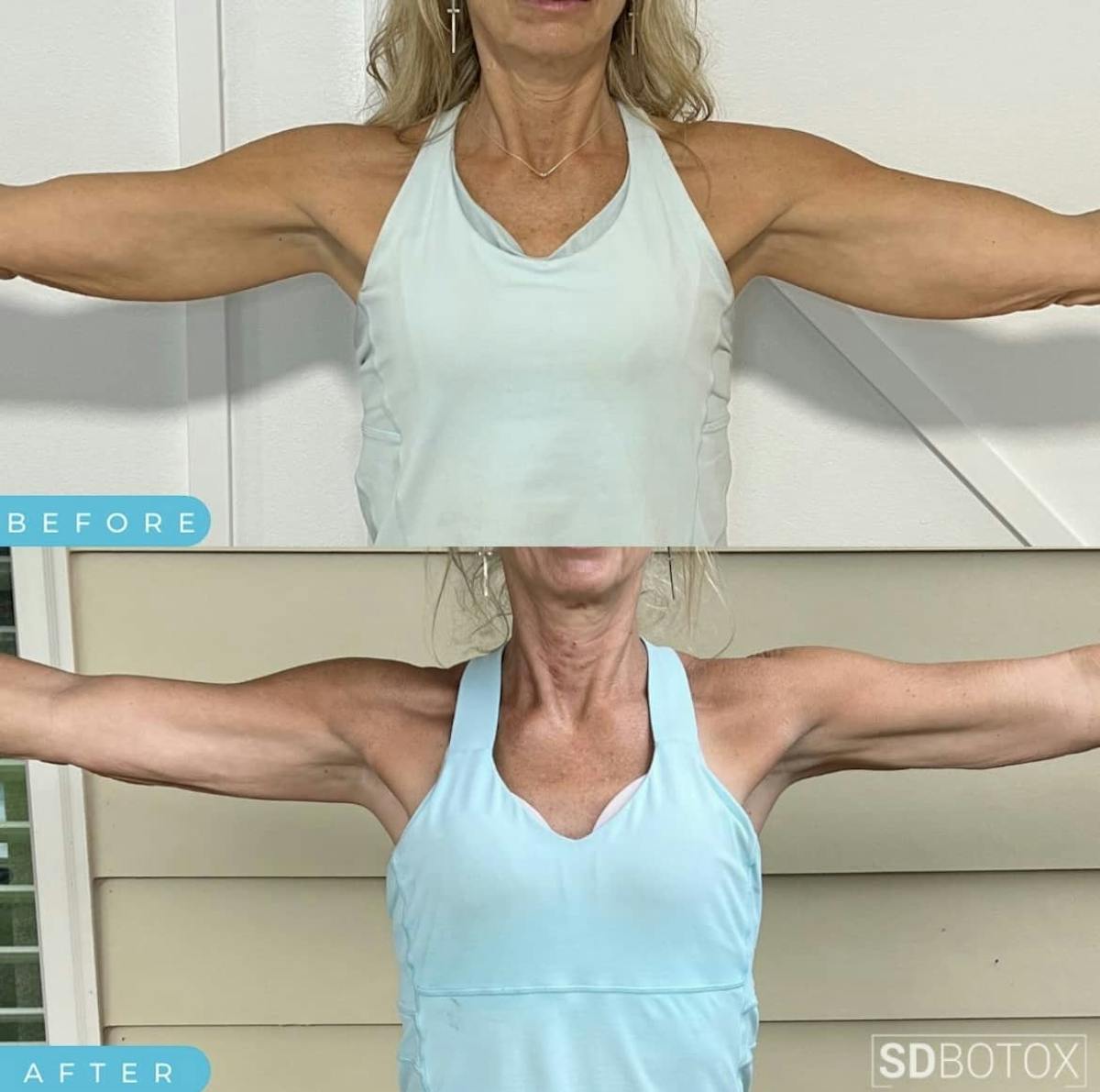 Coolsculpting Before & After Gallery - Patient 187087365 - Image 3