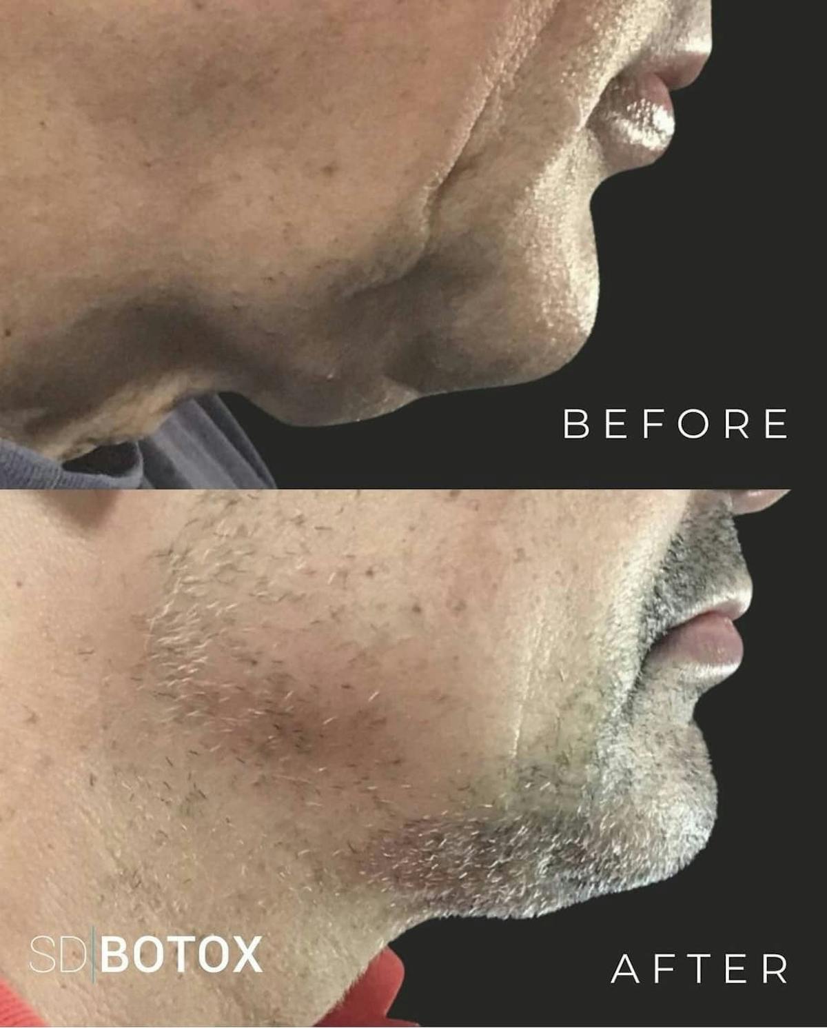 Coolsculpting Before & After Gallery - Patient 187087369 - Image 1