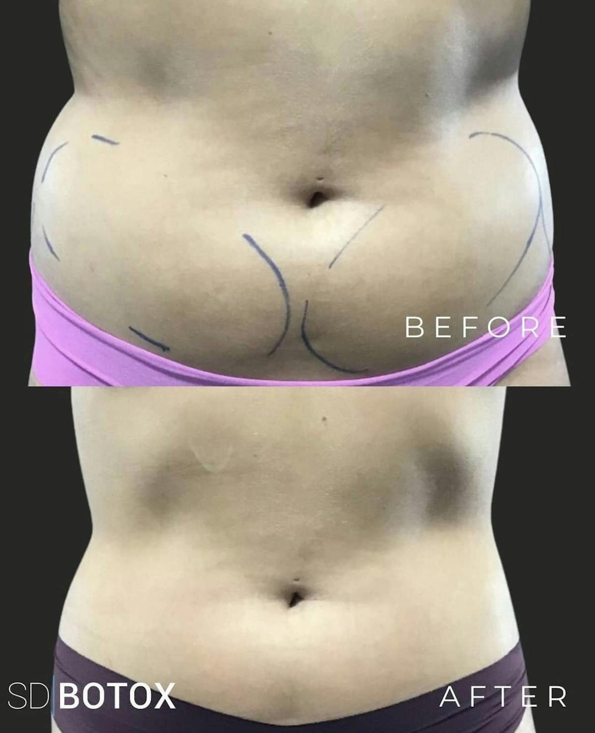 Coolsculpting Before & After Gallery - Patient 187087370 - Image 1