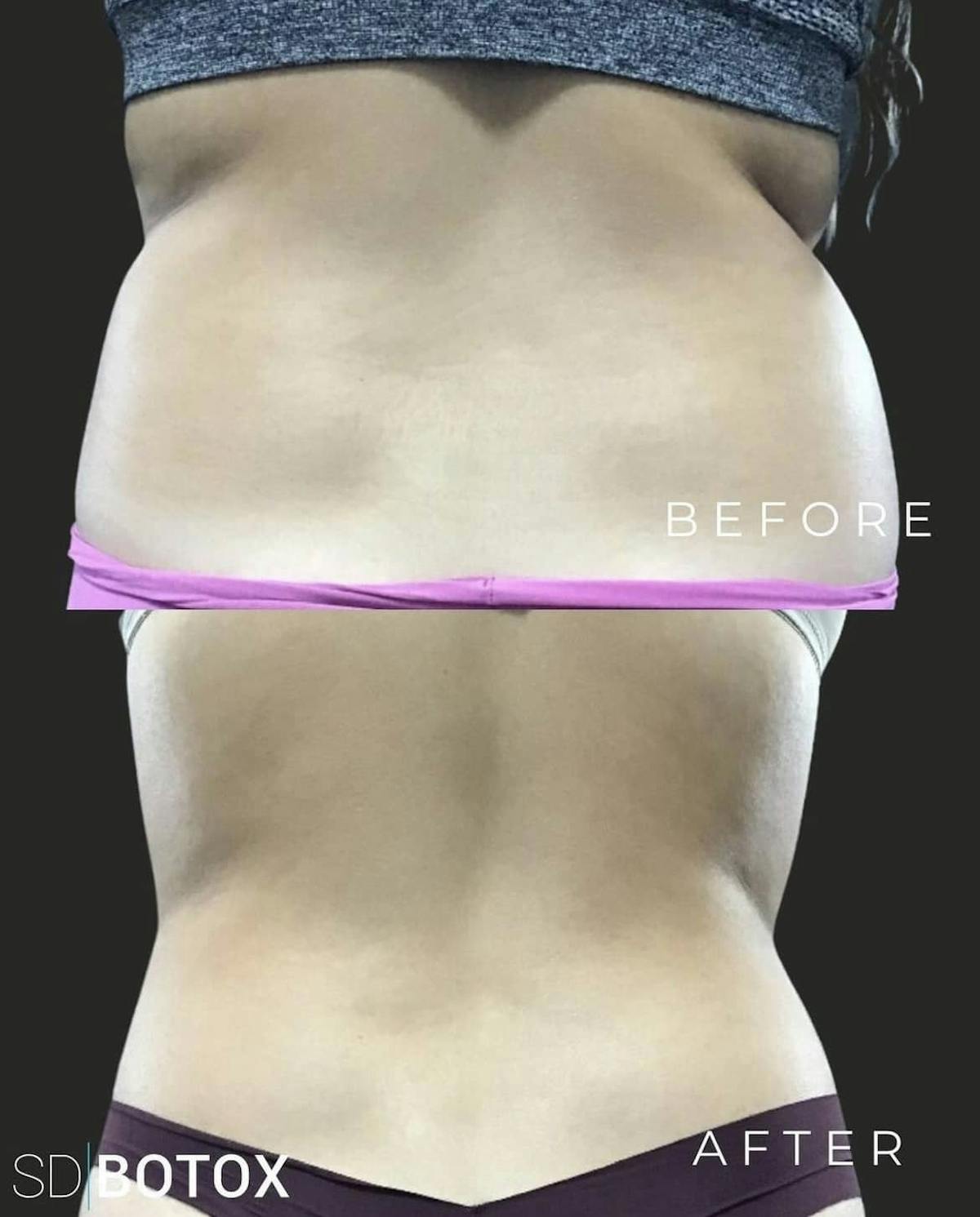 Coolsculpting Before & After Gallery - Patient 187087370 - Image 2