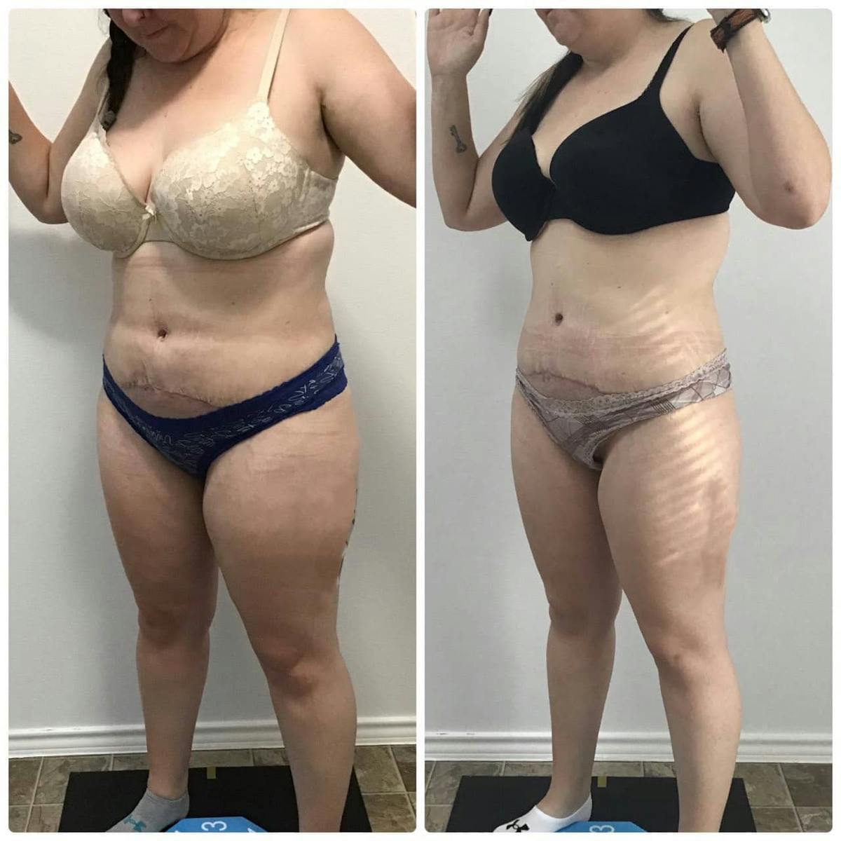 Coolsculpting Before & After Gallery - Patient 187087364 - Image 2