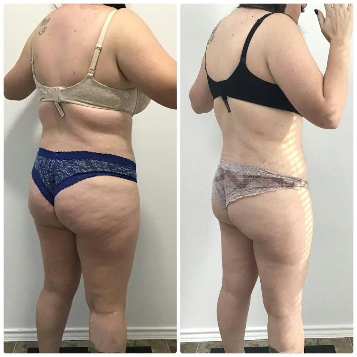 Coolsculpting Before & After Gallery - Patient 187087364 - Image 3