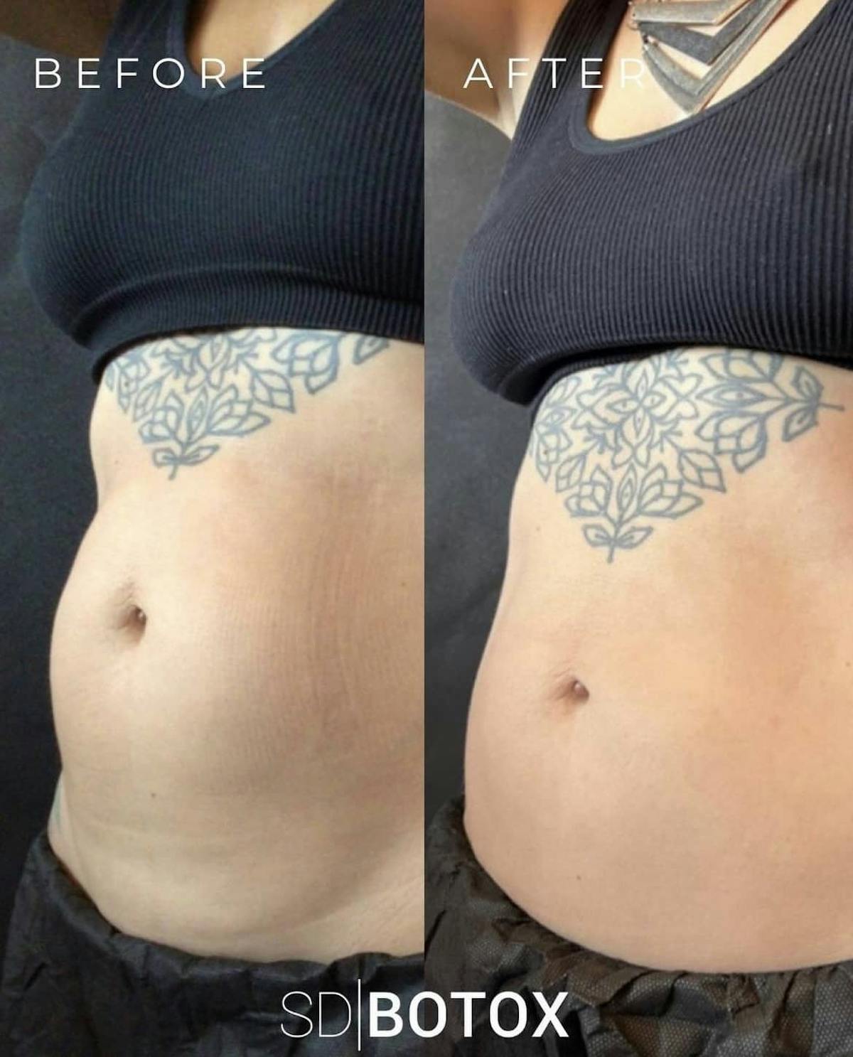 Coolsculpting Before & After Gallery - Patient 187087371 - Image 1