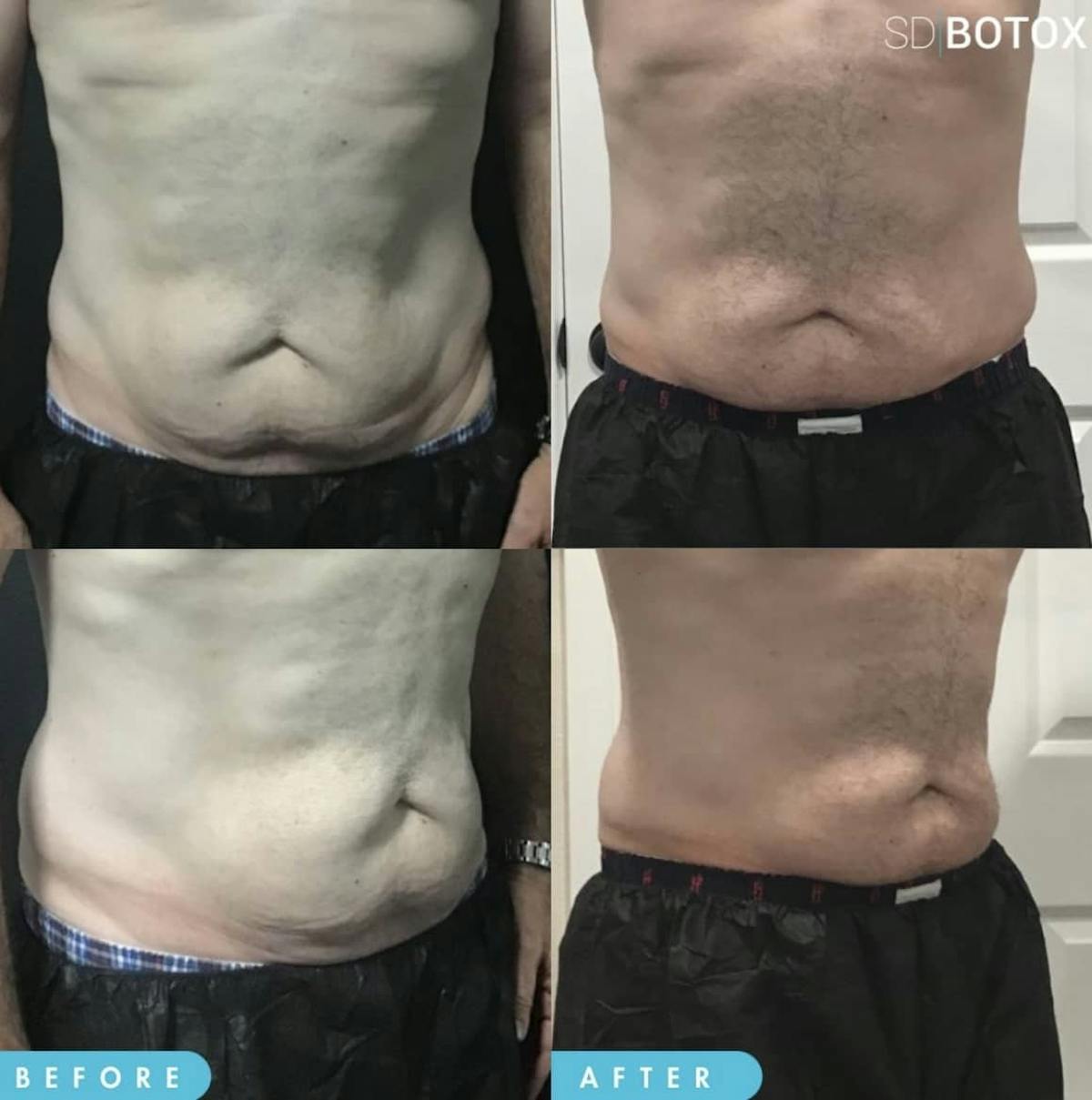 Coolsculpting Before & After Gallery - Patient 187087372 - Image 1