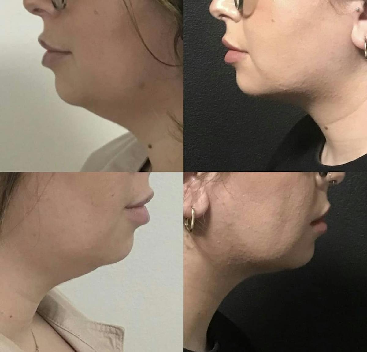 Coolsculpting Before & After Gallery - Patient 187087373 - Image 1