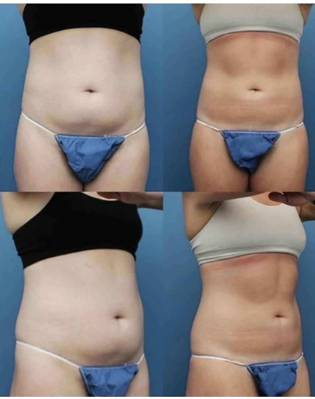 Coolsculpting Before & After Gallery - Patient 187087374 - Image 1