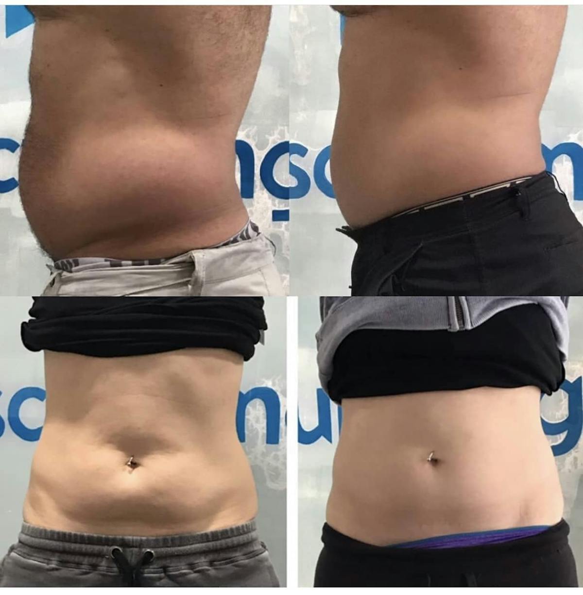 Coolsculpting Before & After Gallery - Patient 187087375 - Image 1
