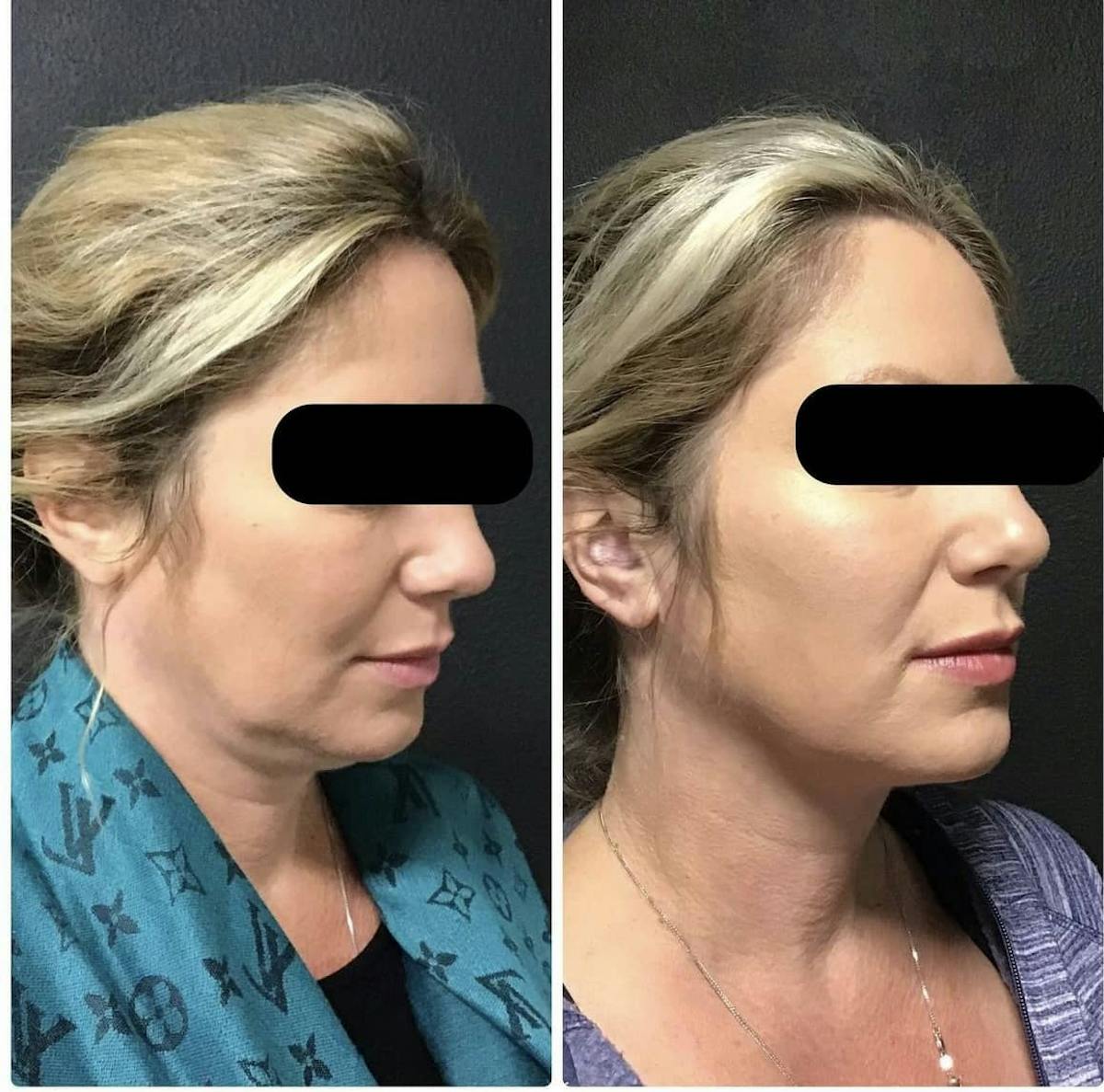 Coolsculpting Before & After Gallery - Patient 187087376 - Image 1
