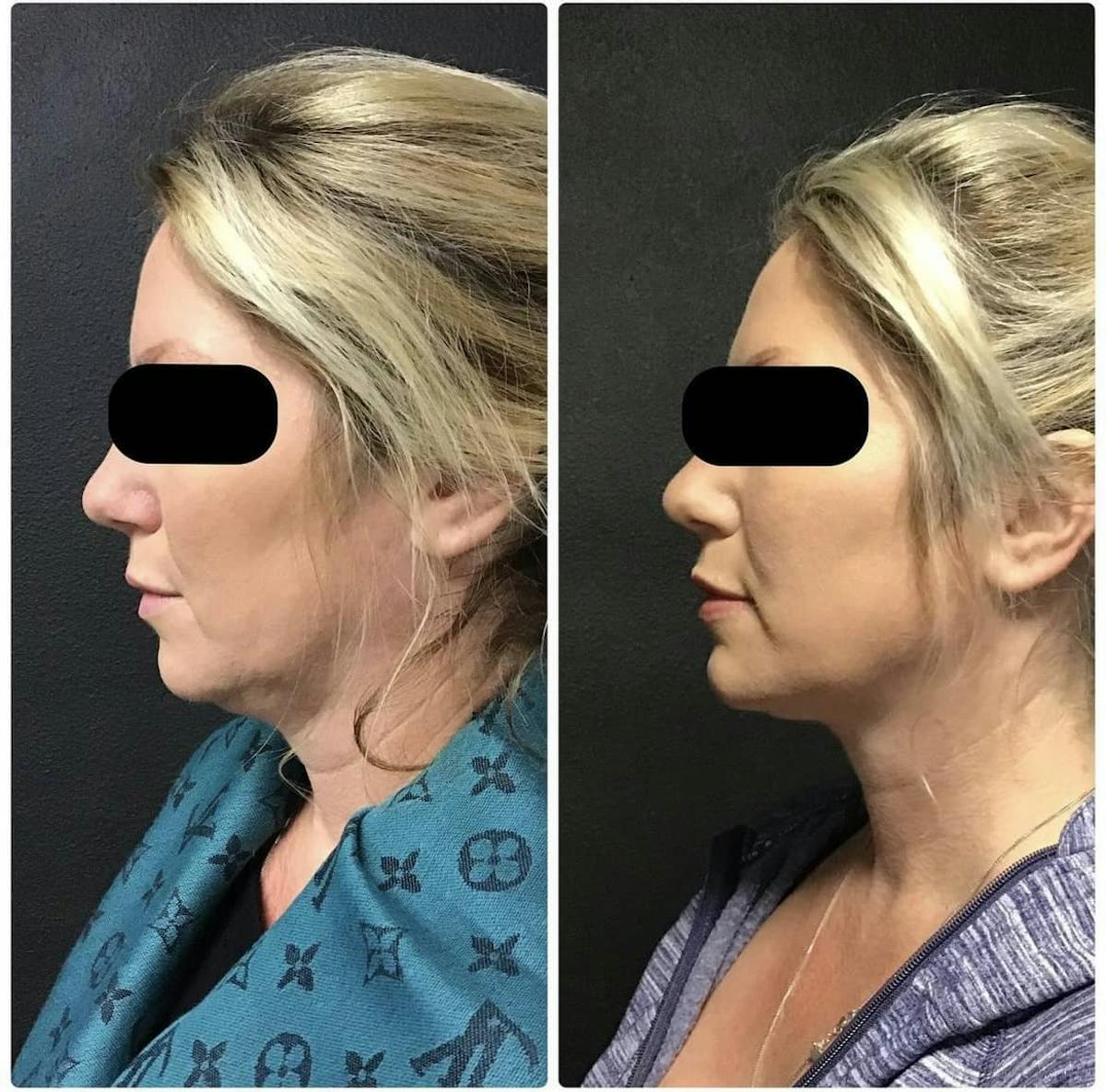 Coolsculpting Before & After Gallery - Patient 187087376 - Image 2