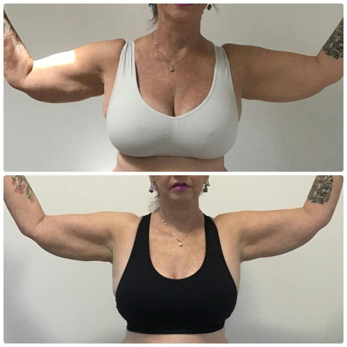Coolsculpting Before & After Gallery - Patient 187087446 - Image 1