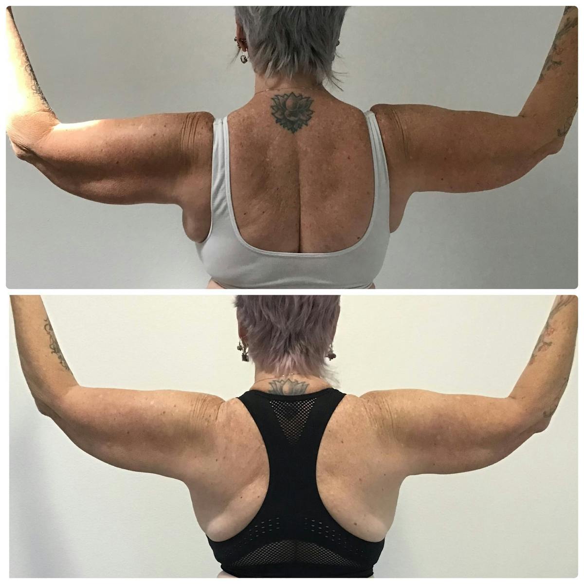 Coolsculpting Before & After Gallery - Patient 187087446 - Image 2