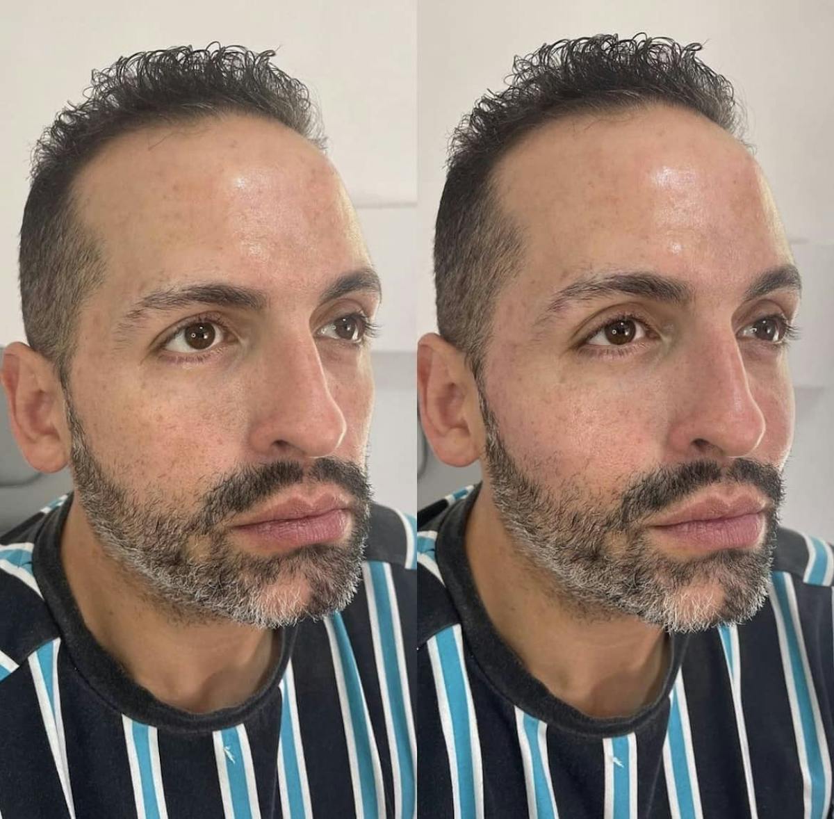 Cheek Filler Before & After Gallery - Patient 187087789 - Image 1
