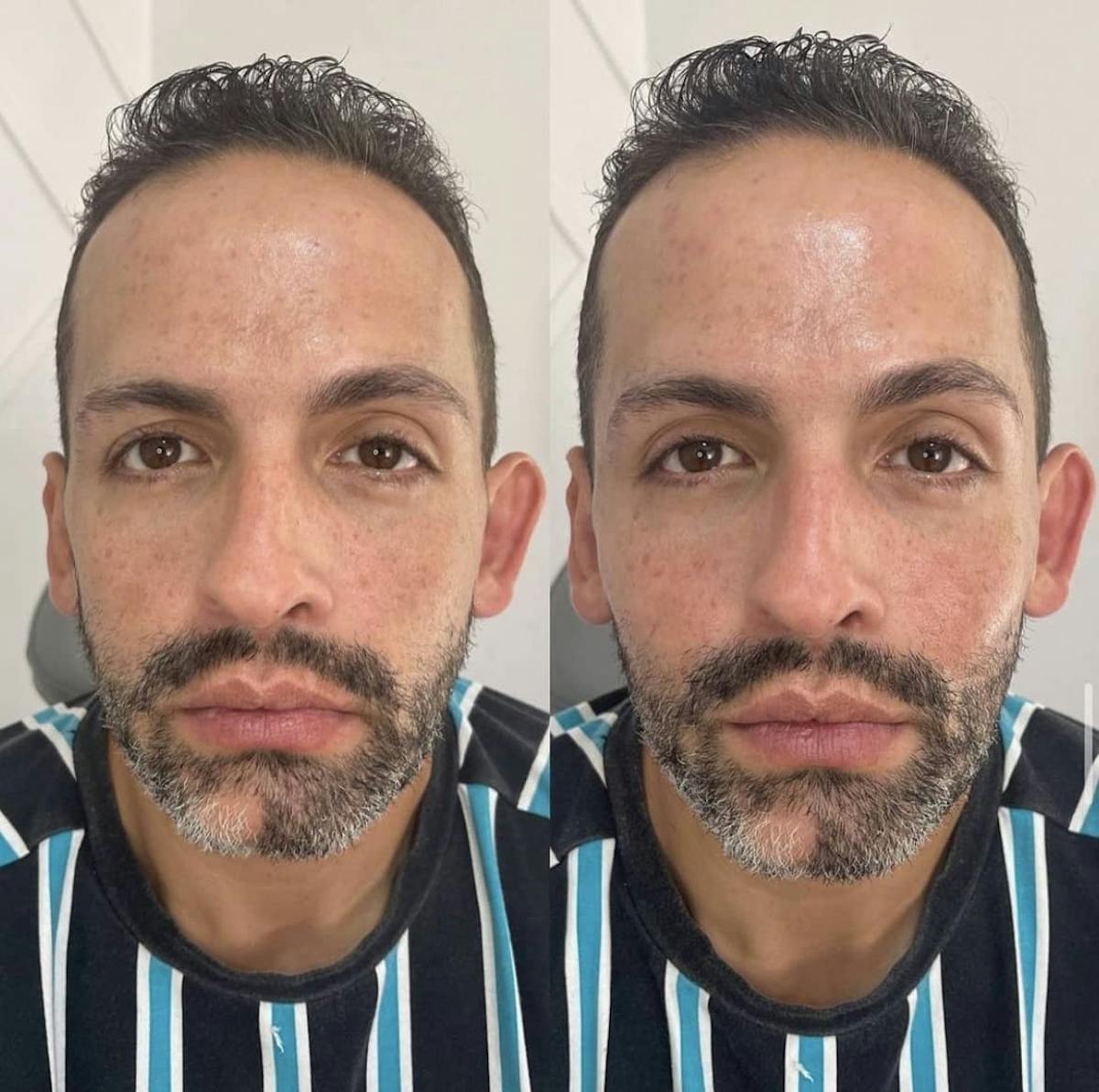 Cheek Filler Before & After Gallery - Patient 187087789 - Image 2