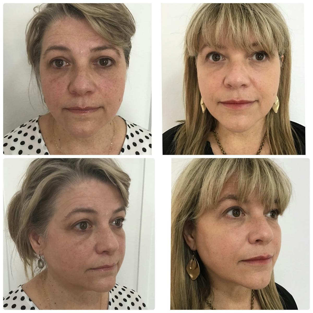 Cheek Filler Before & After Gallery - Patient 187087790 - Image 2