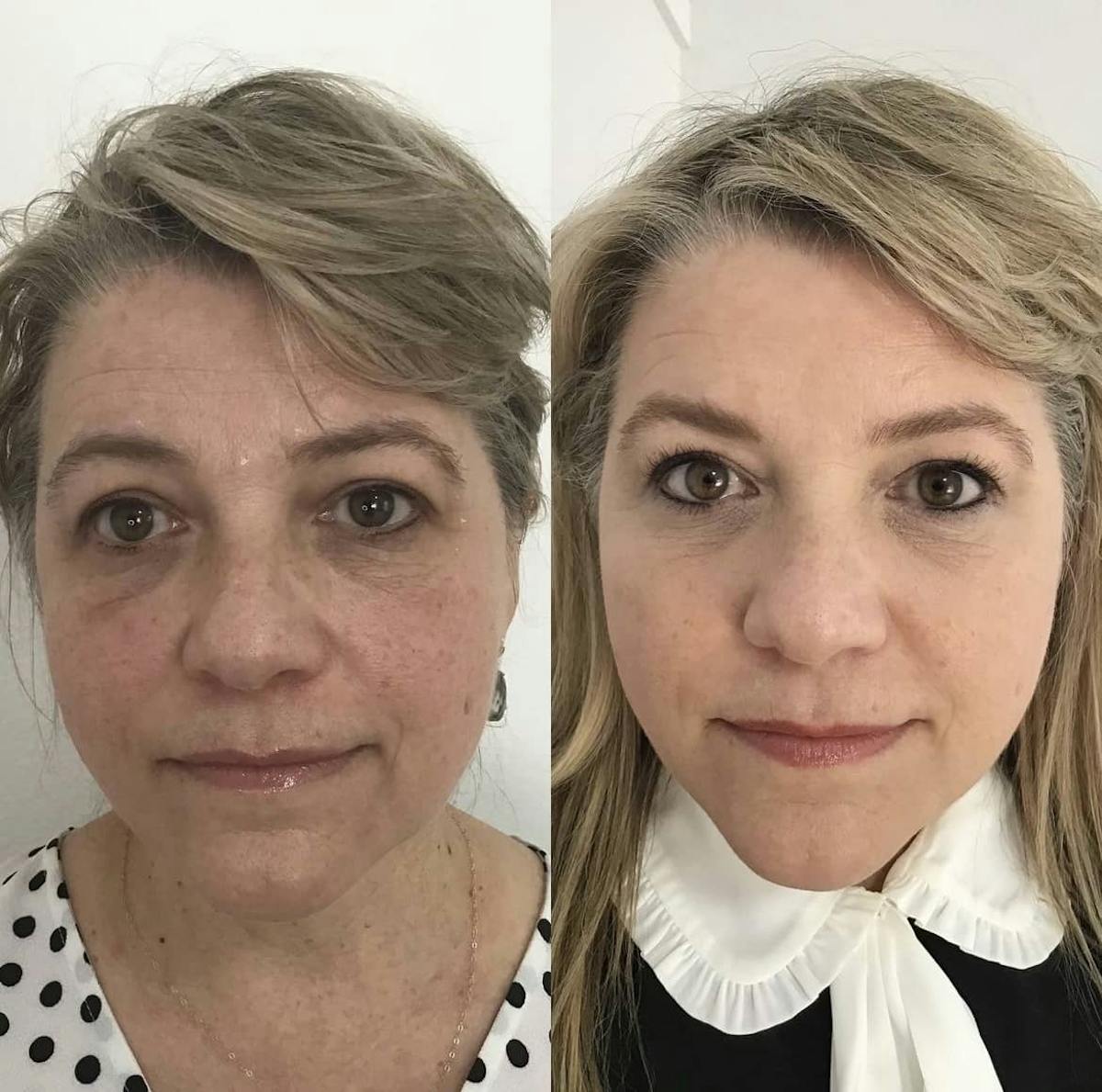 Cheek Filler Before & After Gallery - Patient 187087790 - Image 1