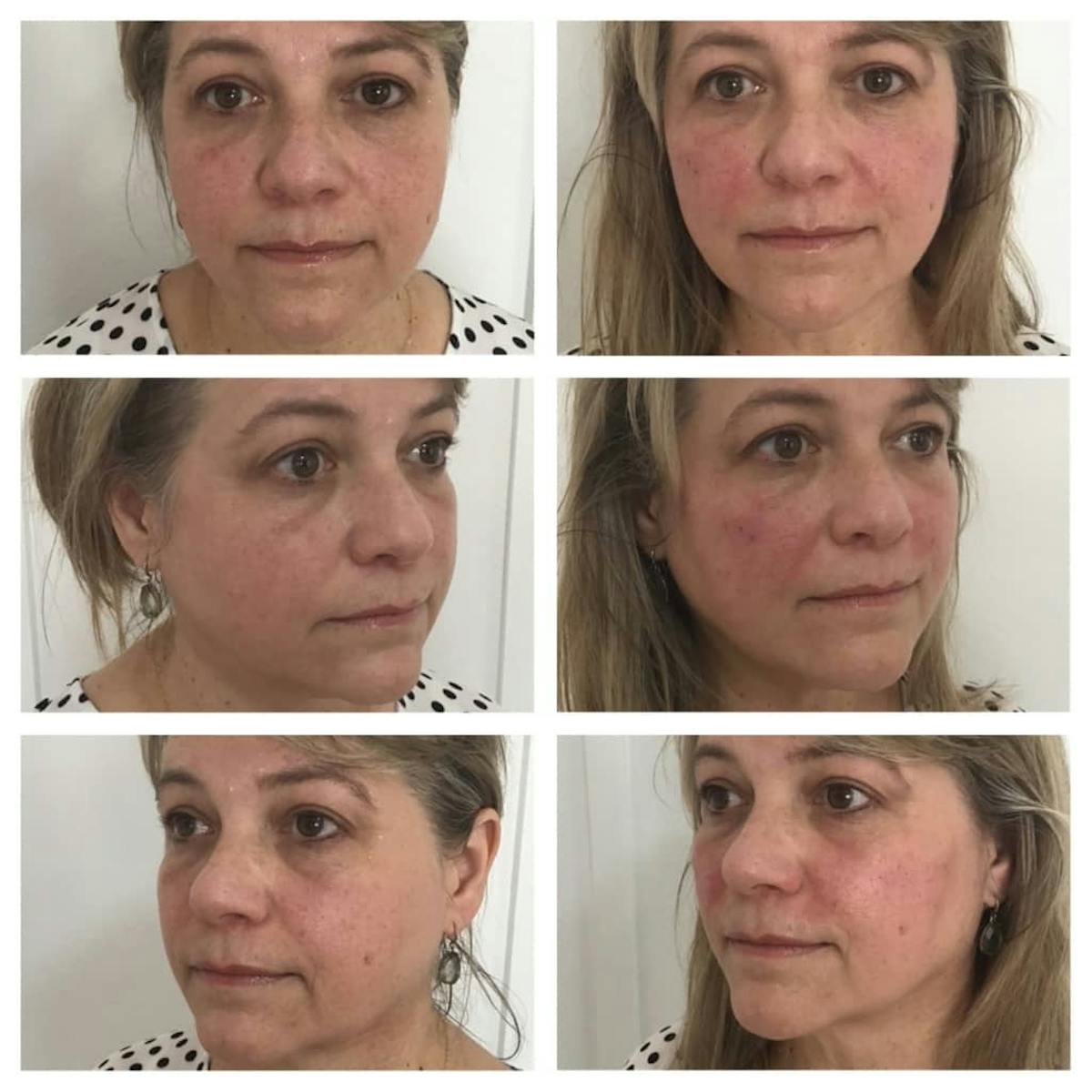 Cheek Filler Before & After Gallery - Patient 187087790 - Image 3