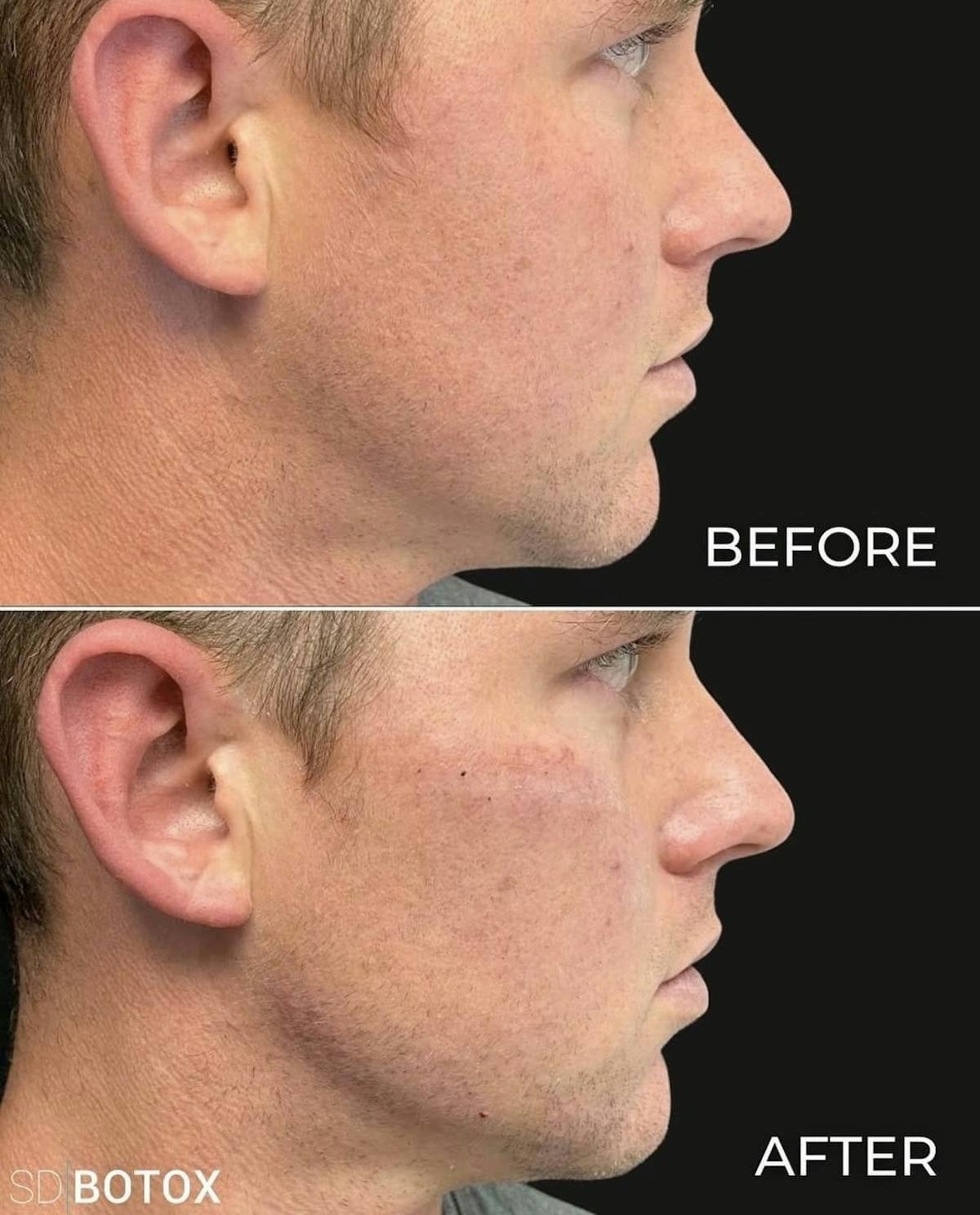 Cheek Filler Before & After Gallery - Patient 187087792 - Image 1