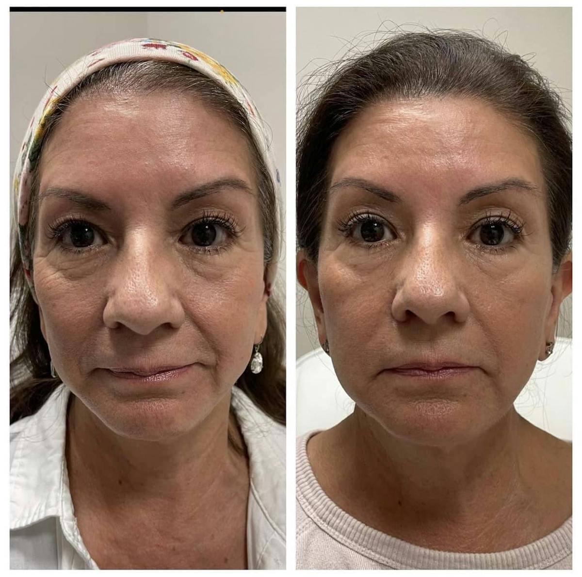 Cheek Filler Before & After Gallery - Patient 187087793 - Image 1