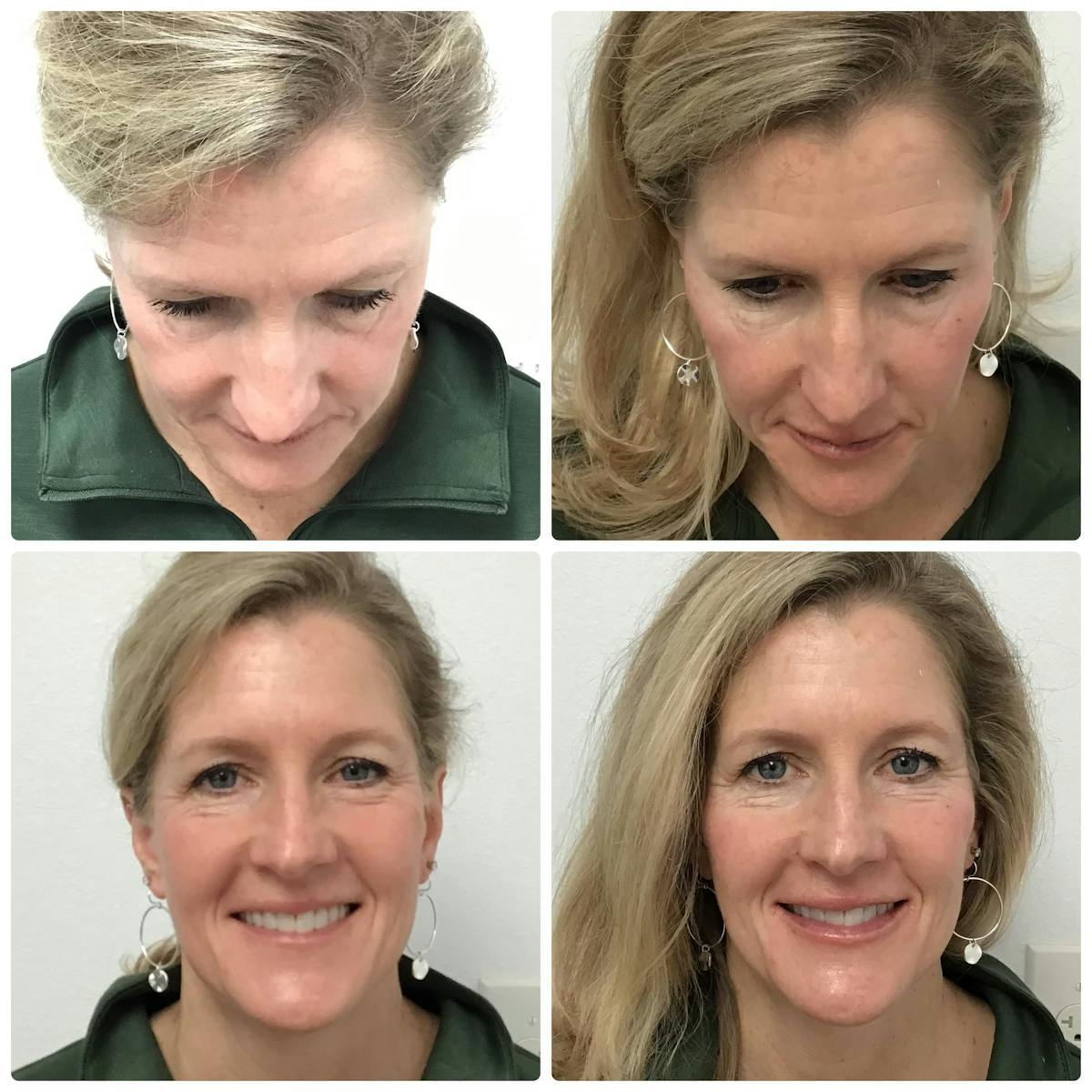 Cheek Filler Before & After Gallery - Patient 187087887 - Image 1