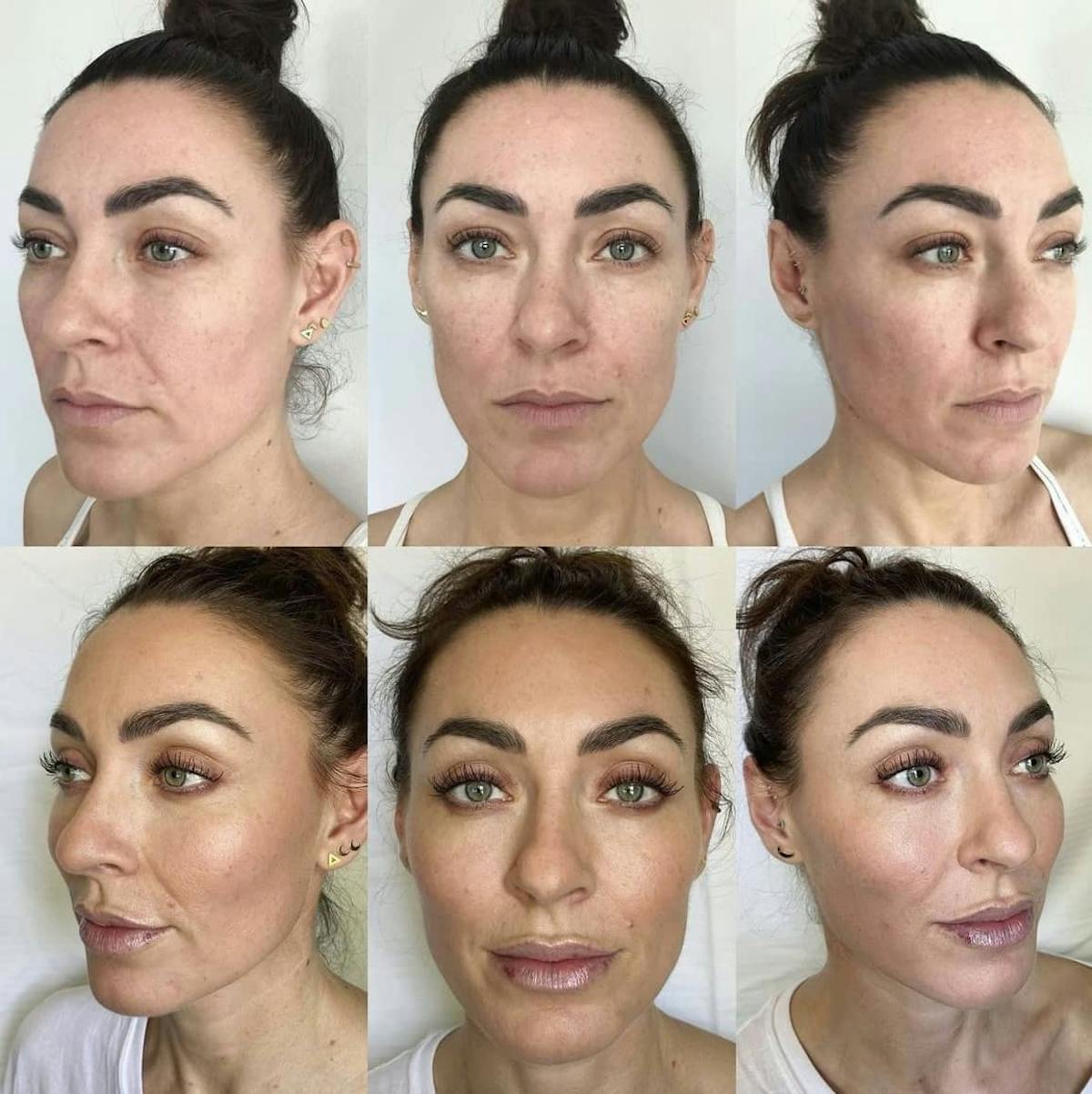 Cheek Filler Before & After Gallery - Patient 187087888 - Image 1