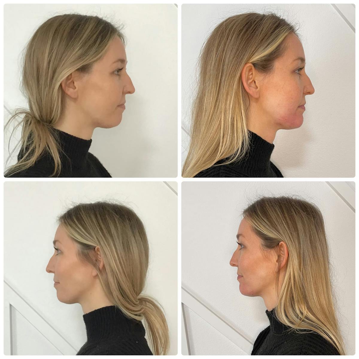 Cheek Filler Before & After Gallery - Patient 187087889 - Image 1