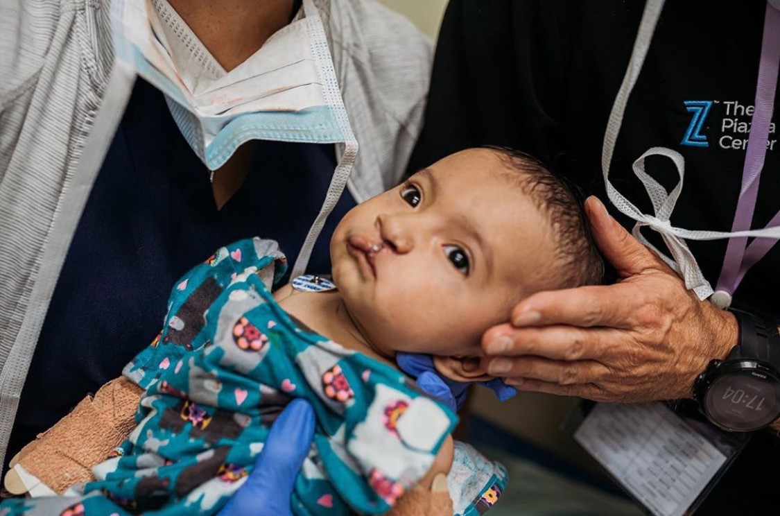 child with cleft lip