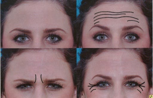 Botox patient