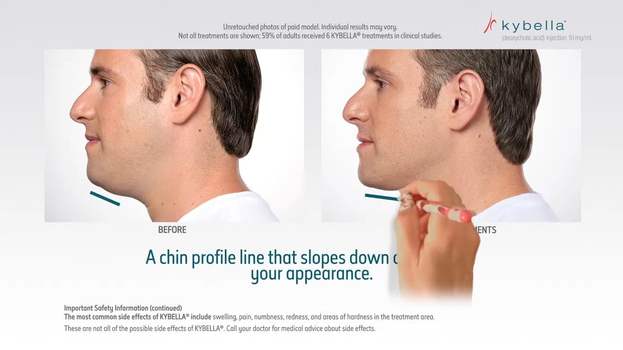 Kybella infographic