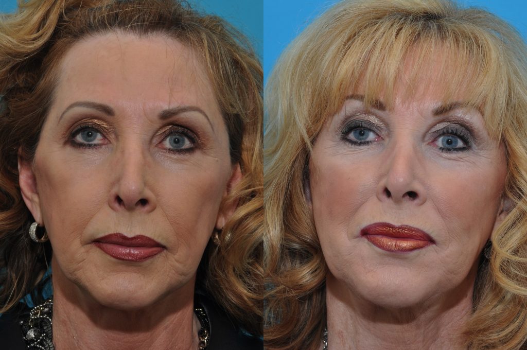 An actual patient one week after 3 syringes of Juvederm Ultra Plus XC. Notice that volume has been added in the cheeks, and the upper lip has more fullness., the lines from the corners of the mouth to the jaw line are improved