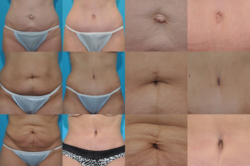 Belly Button Shape Crucial in Austin Tummy Tuck