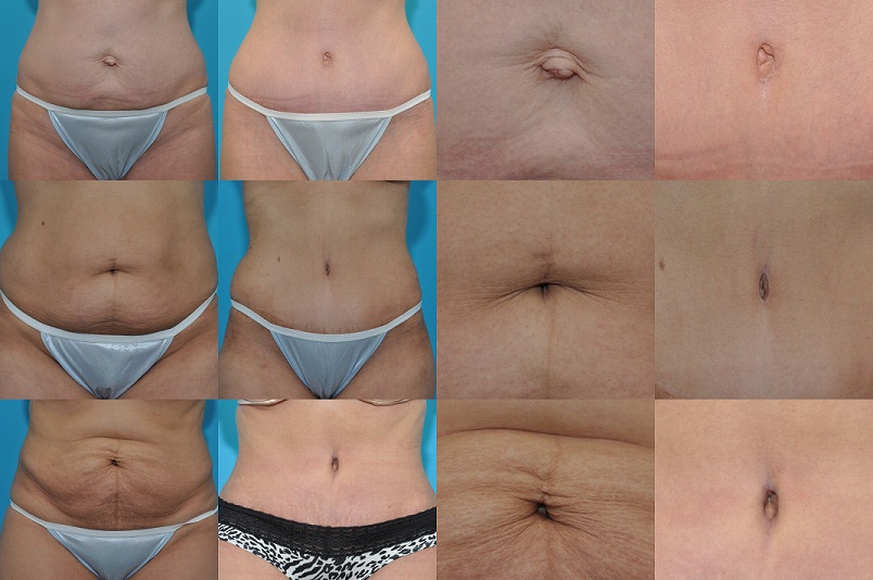 Belly Button in Tummy Tuck_reduced size Belly Button in Tummy Tuck_reduced size