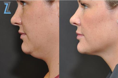 Kybella before and after