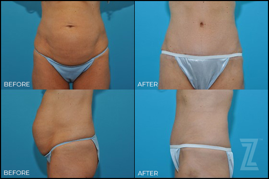 Tummy tuck before and after