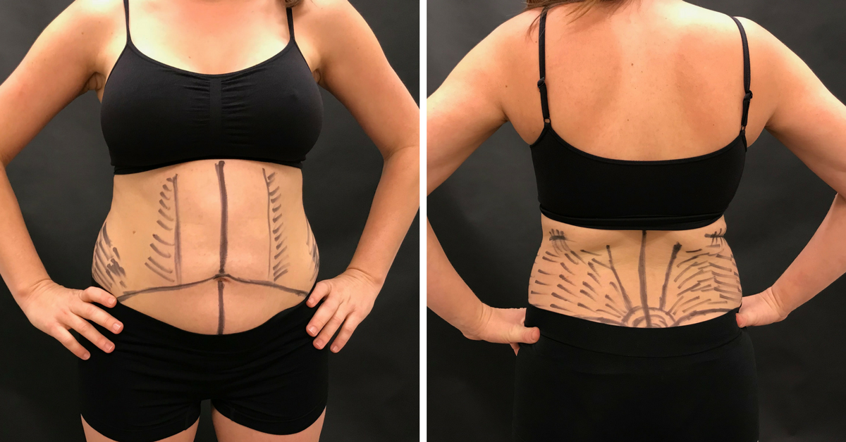 Tummy tuck before and after