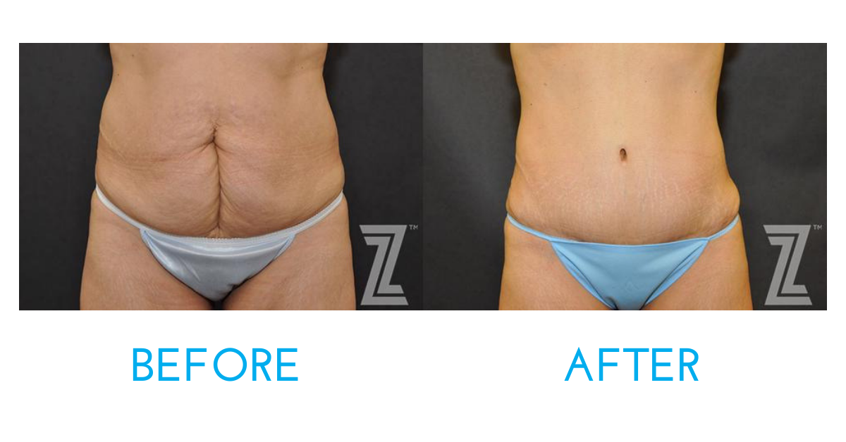 Tummy tuck before and after photos front view