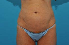Before Front