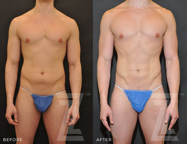 Before-and-After-Male-Body-Contouring