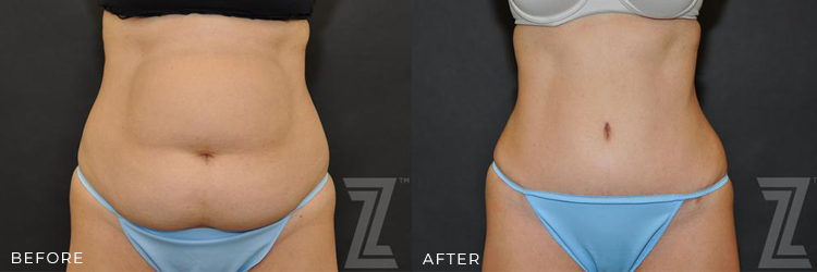 Before and After a Tummy Tuck