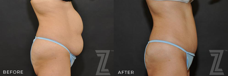 Before-and-After-Tummy-Tuck-Diastis-Recti