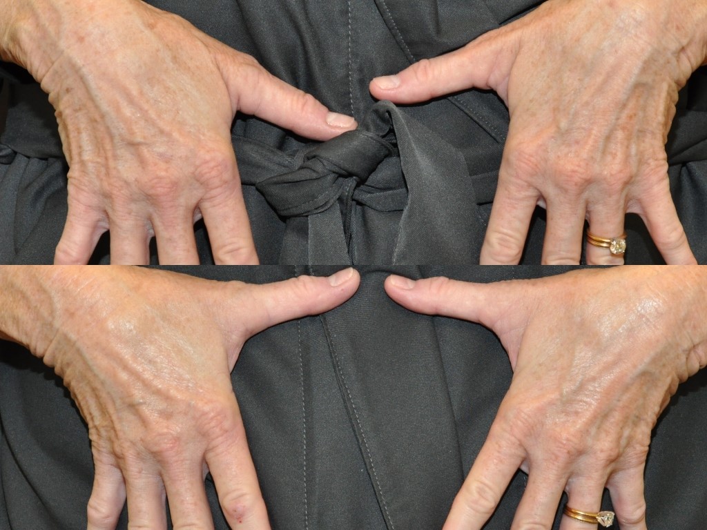 Hand rejuvenation: before and after 3 IPL treatments