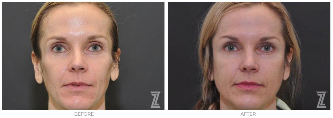 Sculptra results at The Piazza Center