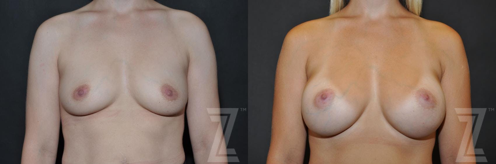 Breast Augmentation Before & After Gallery - Patient 132790600 - Image 1