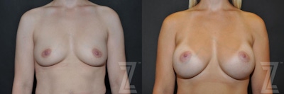 Breast Augmentation Before & After Gallery - Patient 132790600 - Image 1