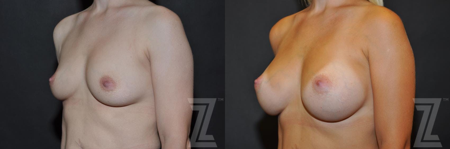 Breast Augmentation Before & After Gallery - Patient 132790600 - Image 2
