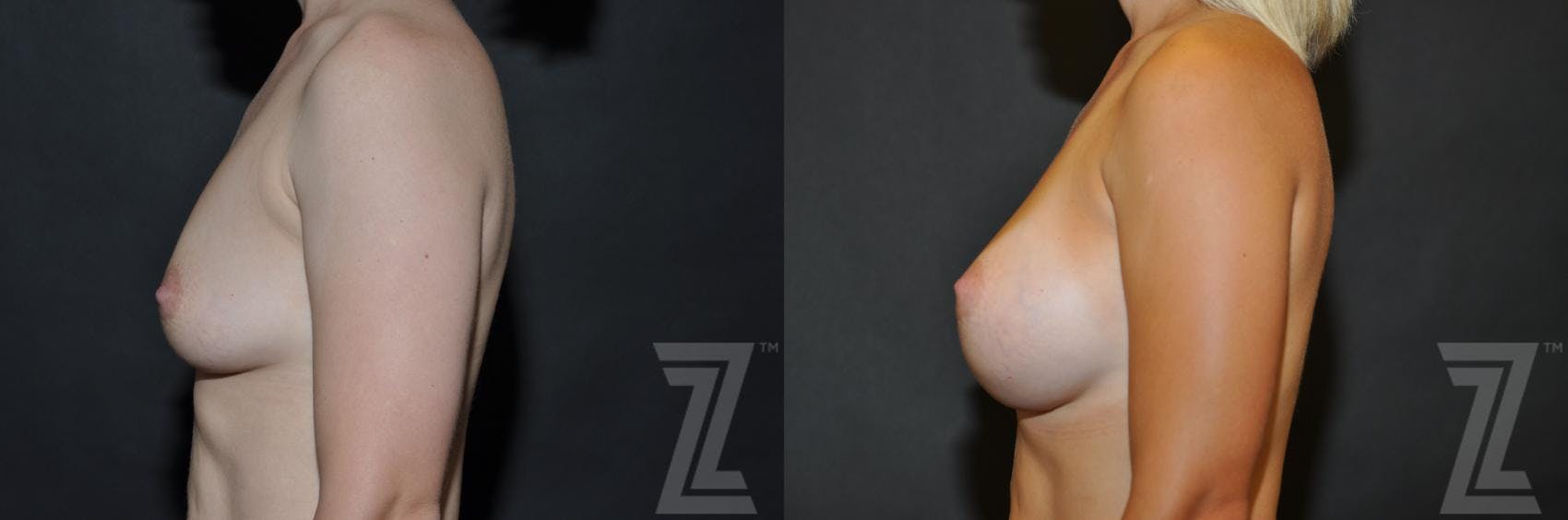 Breast Augmentation Before & After Gallery - Patient 132790600 - Image 3